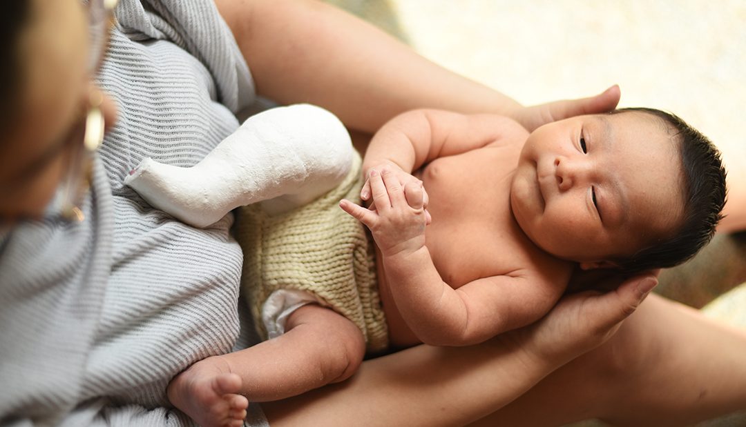 Clubfoot: What Parents Need To Know