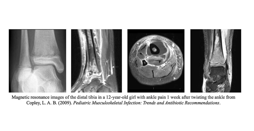 Magnetic resonance images of the distal tibia in a 12 year old girl with ankle pain | Magnetic resonance images of the distal tibia in a 12-year-old girl with ankle pain 1 week after twisting the ankle from Copley, L. A. B. (2009). Pediatric Musculoskeletal Infection: Trends and Antibiotic Recommendations.